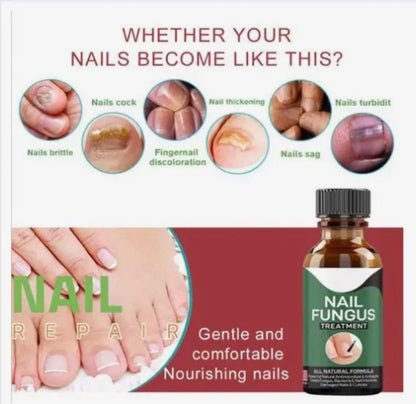 Fast Nail Fungus Treatment Serum 15ml All Natural Formula For Finger And Toenail Care Repairs Damaged Nails Cuticles And Supports Healthy Growth