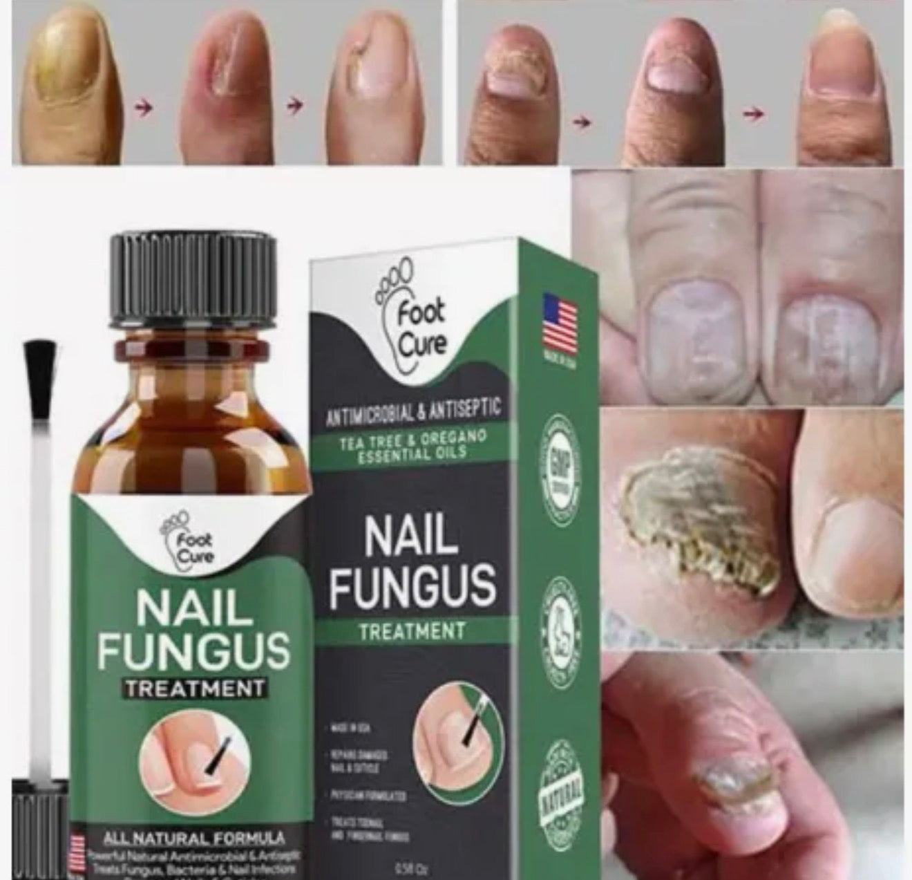 Fast Nail Fungus Treatment Serum 15ml All Natural Formula For Finger And Toenail Care Repairs Damaged Nails Cuticles And Supports Healthy Growth